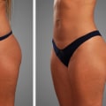Sculpt And Soothe: How Liposuction In Scottsdale Can Help Relieve Neck Pain